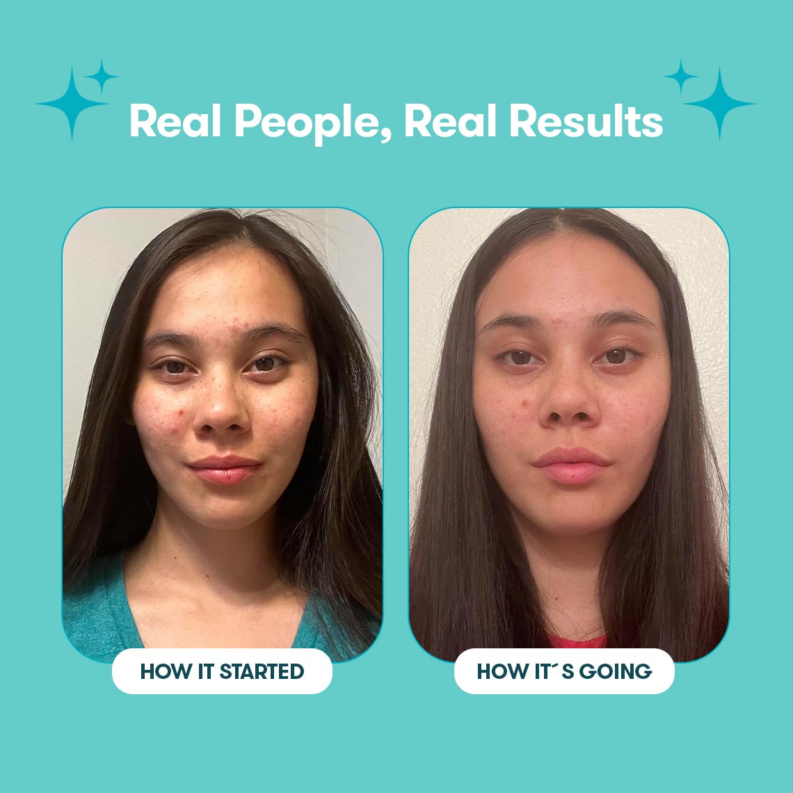 05_Proactiv_Gentle_Bundle_PimplePatches_RealPeople_RealResults2.jpg