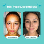 05_Proactiv_Solution_PimplePatches_Testimonials2.jpg