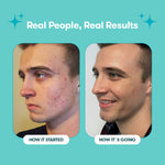 Vorher-nachher Vergleich mit Proactiv Solution – sichtbare Hautverbesserung bei junger Person.