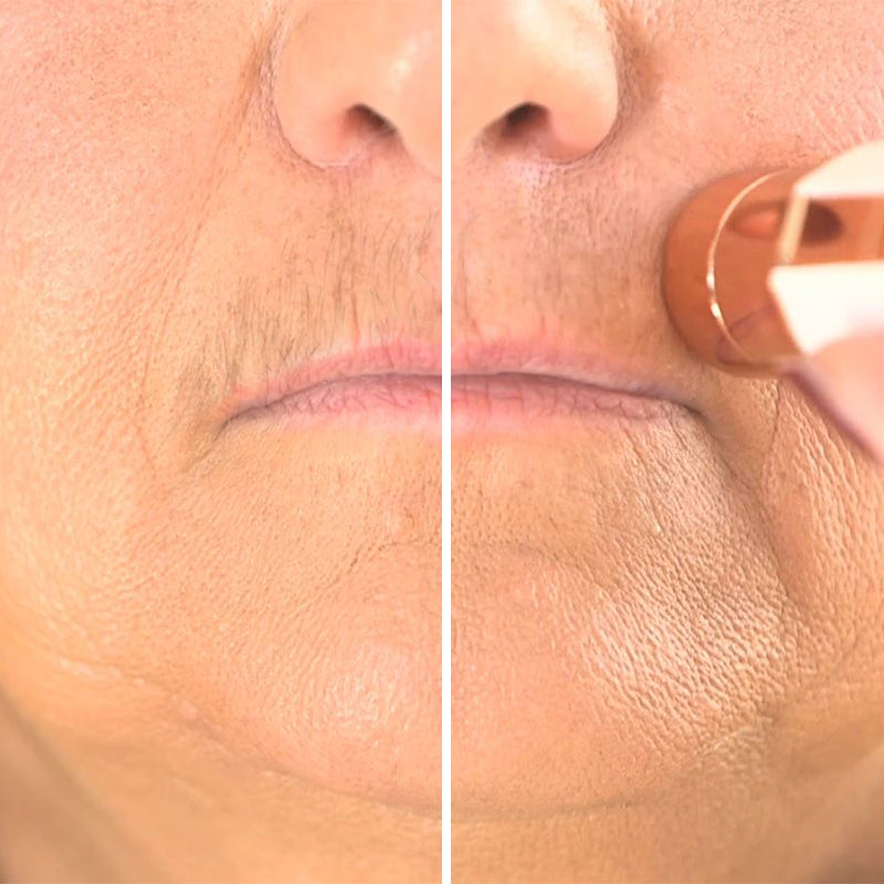 Vorher-nachher-Vergleich der Oberlippe zeigt effektive Haarentfernung mit dem Roxy Pocket Shaver.