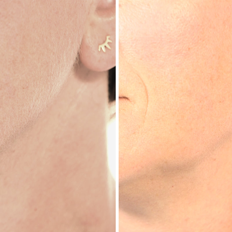 Vorher-nachher-Vergleich an der Wange: feine Gesichtshärchen mit dem Roxy Pocket Shaver sanft entfernt.