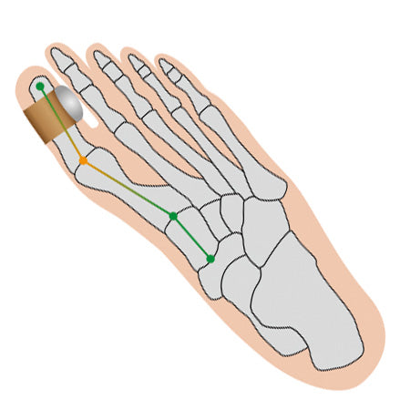 Grafik der Fußknochen mit dem Hallux Softkissen zur sanften Korrektur bei Hallux valgus